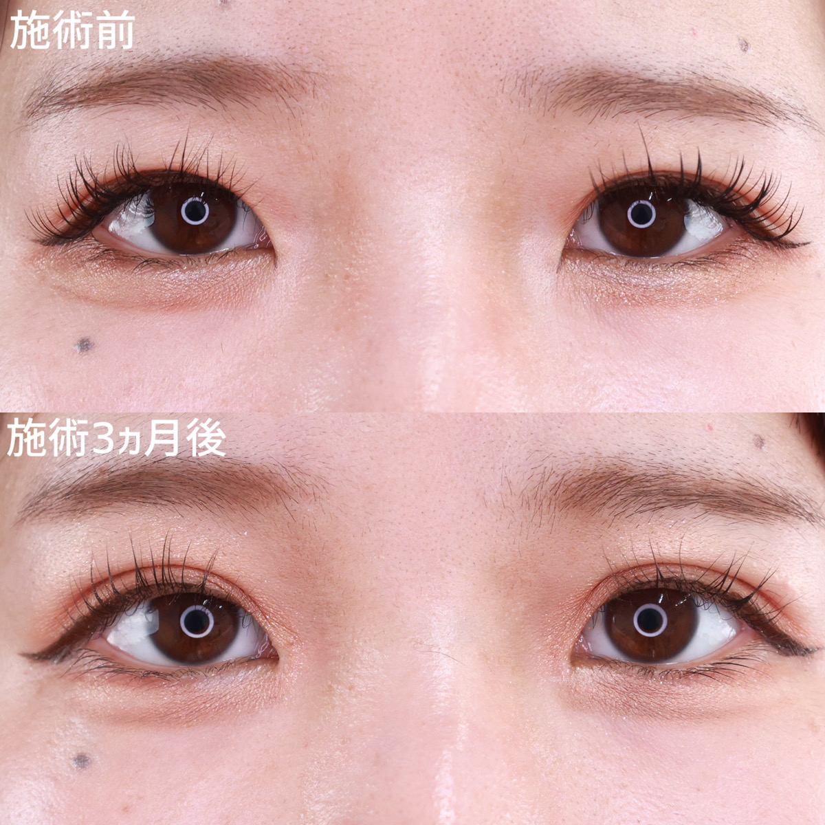 【二重整形】目頭切開術を併用し華やかな目元へ
