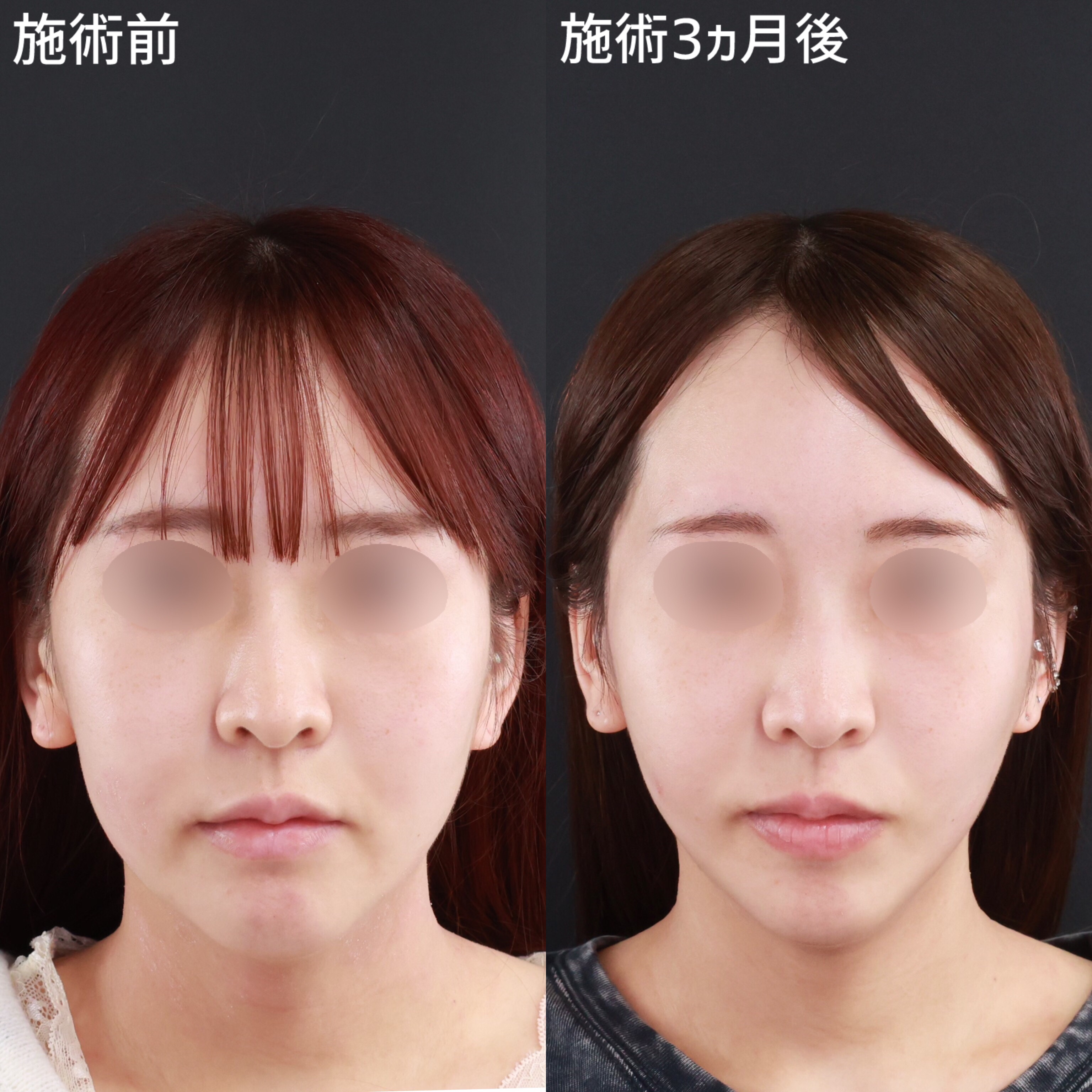 スレッドリフトの症例写真・画像・ビフォーアフター｜美容整形