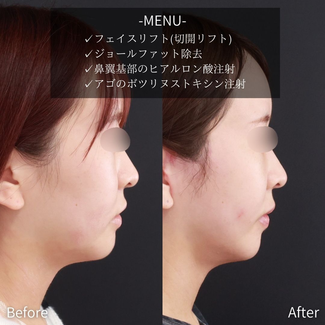 フェイスリフト（切開）/ジョールファット除去/ヒアルロン酸注射：その他の症例写真 施術前後 