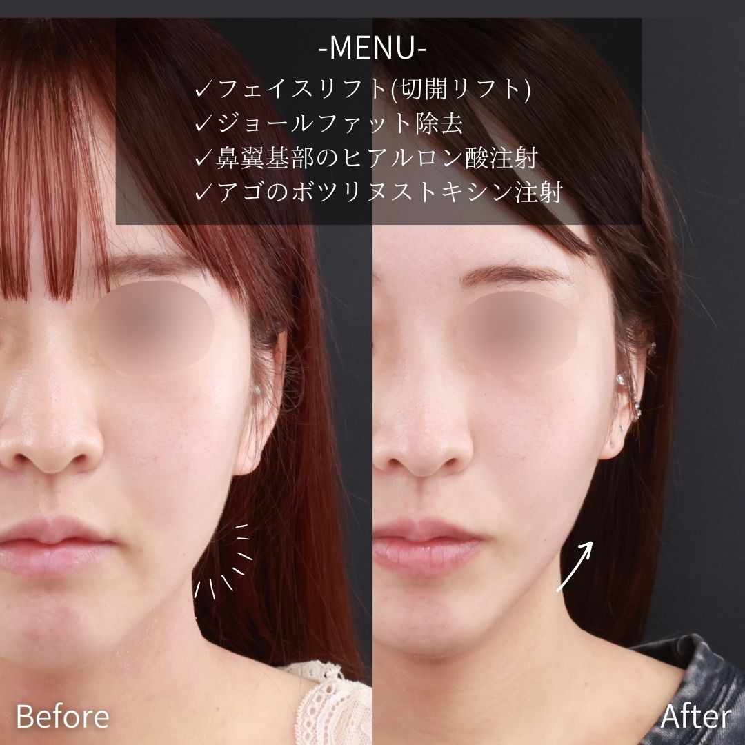 フェイスリフト（切開）/ジョールファット除去/ヒアルロン酸注射：その他の症例写真 施術前後 
