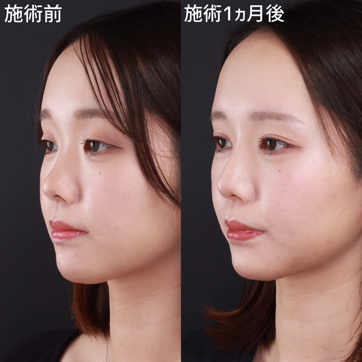 【複合施術】で垢抜け！大人っぽい雰囲気に！