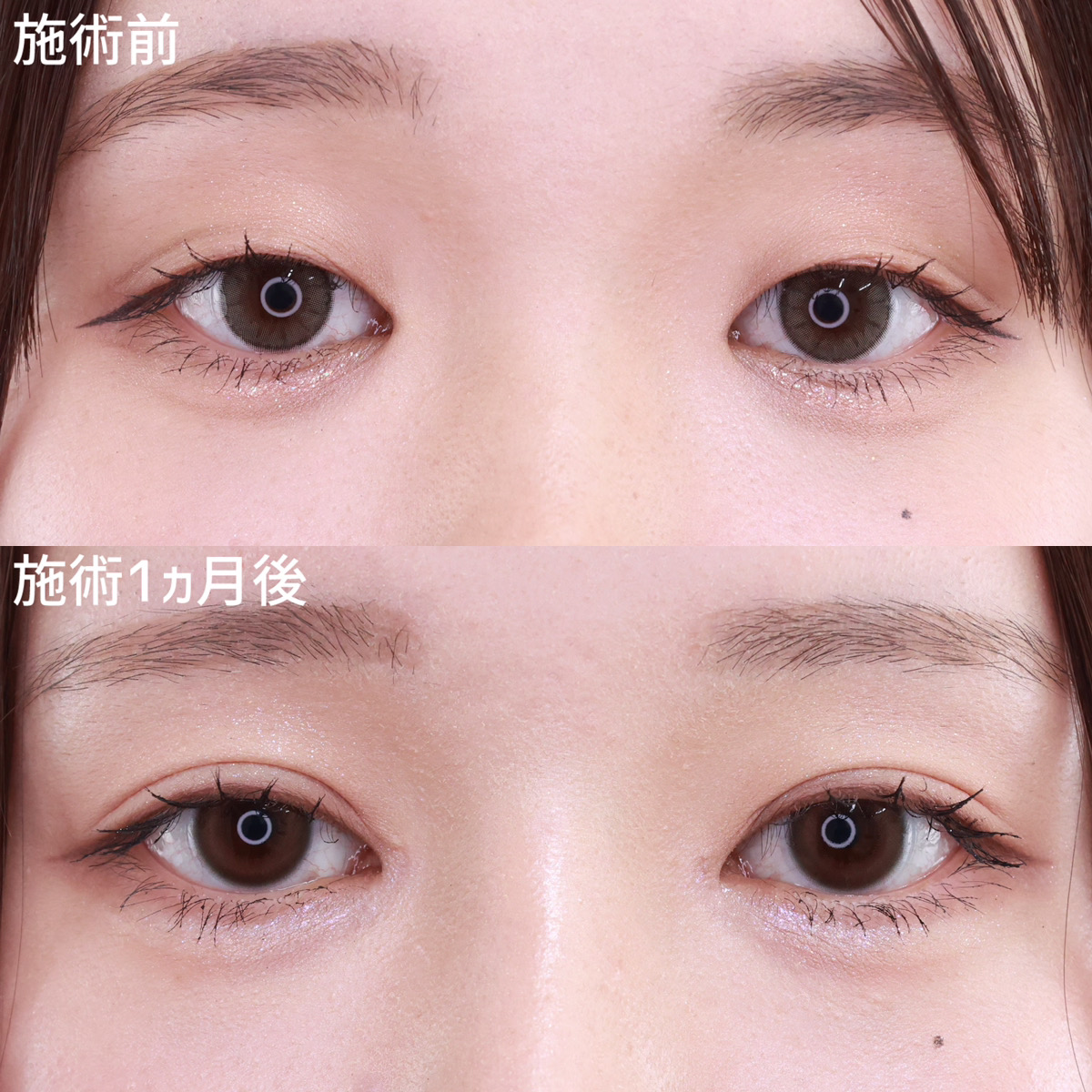 隆鼻術（プロテーゼ・自家組織）/二重埋没法/目頭切開術の症例写真 施術前後 