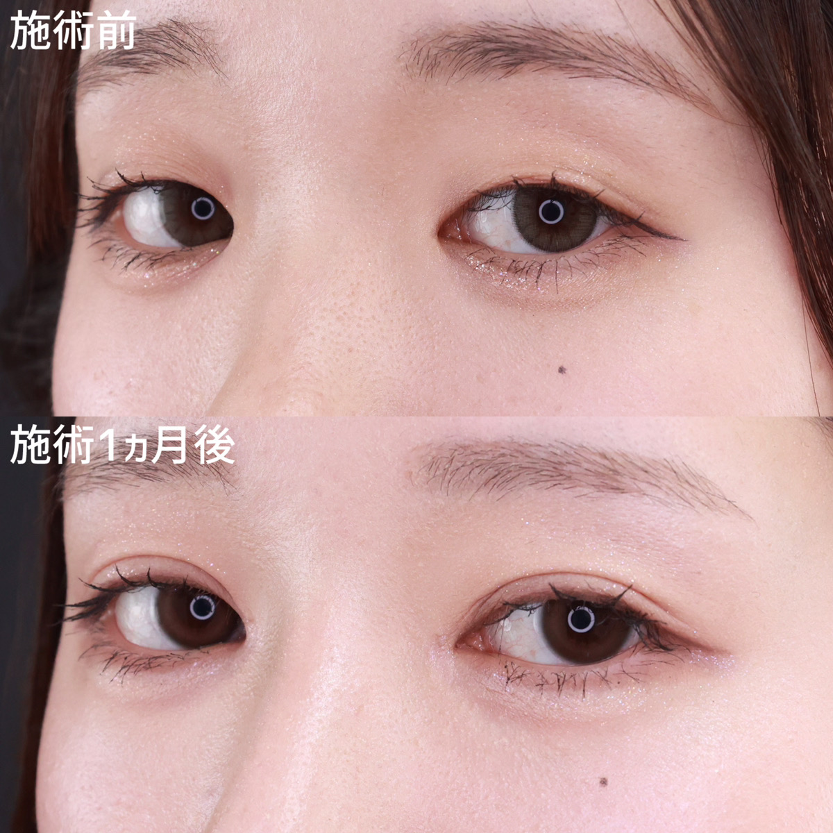 隆鼻術（プロテーゼ・自家組織）/二重埋没法/目頭切開術の症例写真 施術前後 