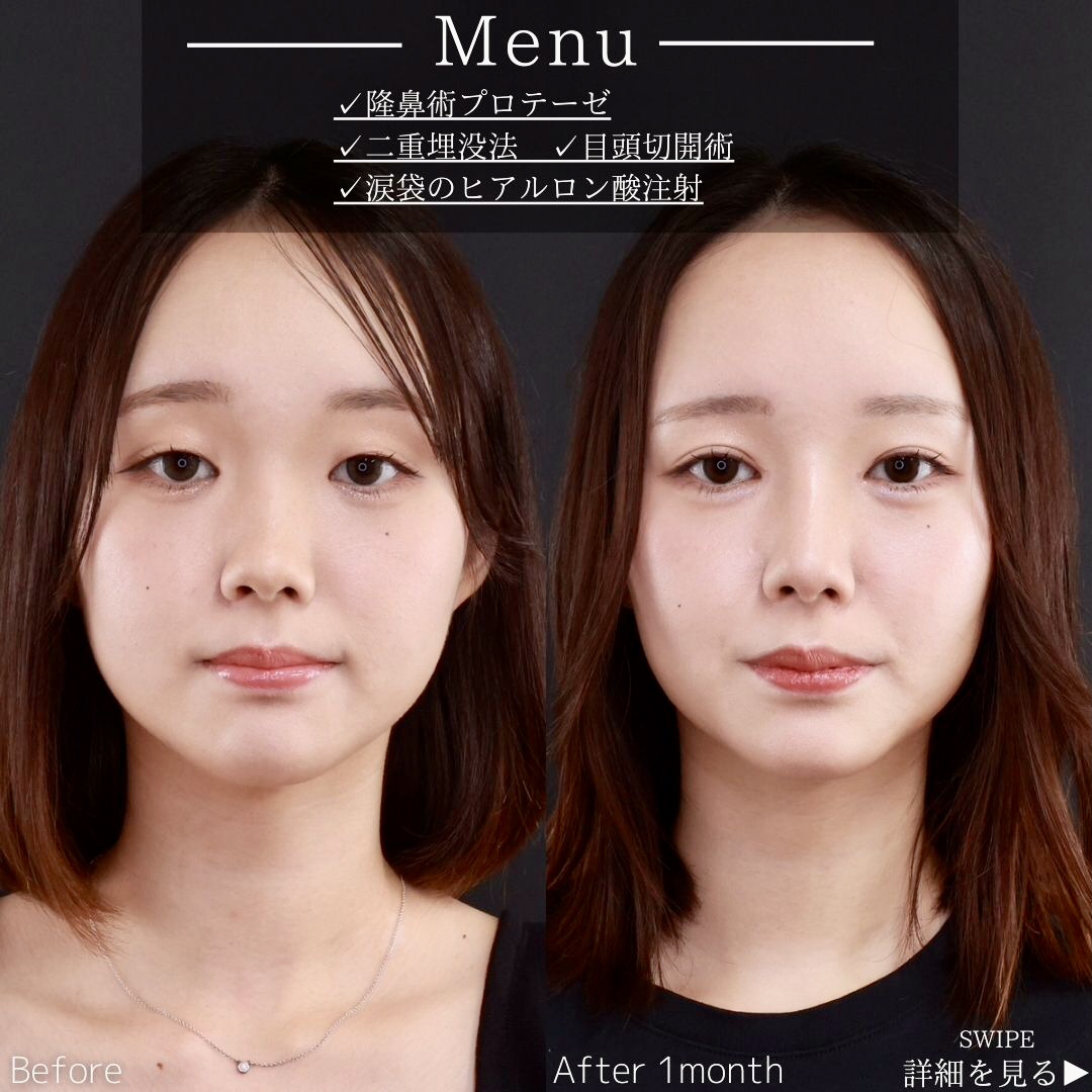 隆鼻術（プロテーゼ・自家組織）/二重埋没法/目頭切開術の症例写真 施術前後 