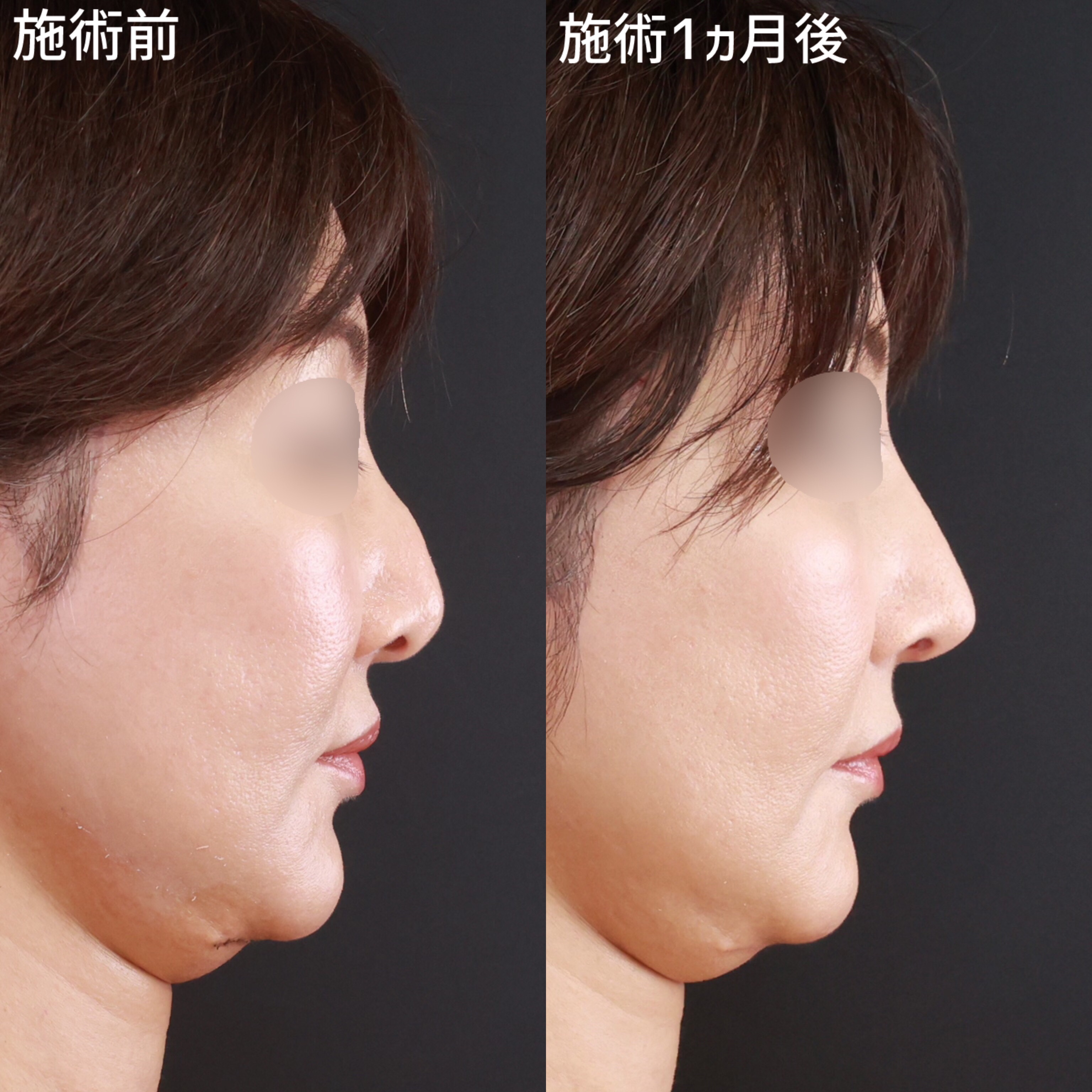 【鼻整形】わし鼻を改善し、美しい鼻筋へ