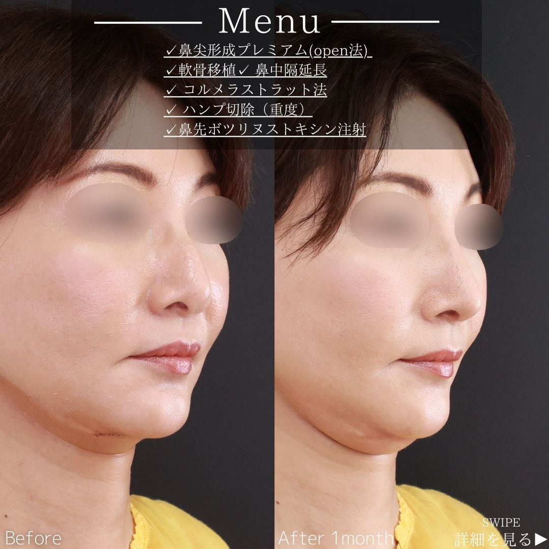 鼻尖形成・鼻尖縮小/鼻先軟骨移植/鼻中隔延長術の症例写真 施術前後 