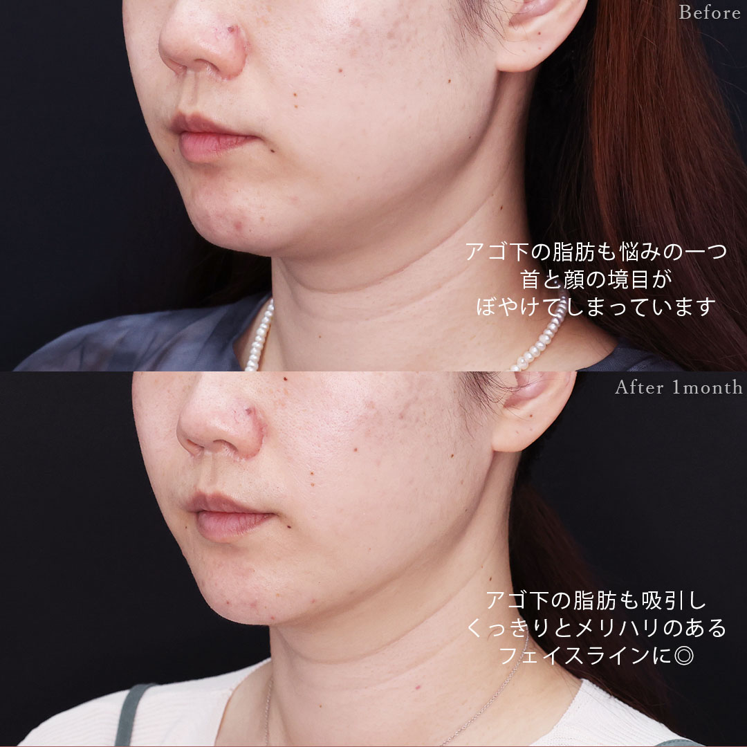TAC式 ツヤ肌コラーゲンリフト®/顔の脂肪吸引の症例写真 施術前後 