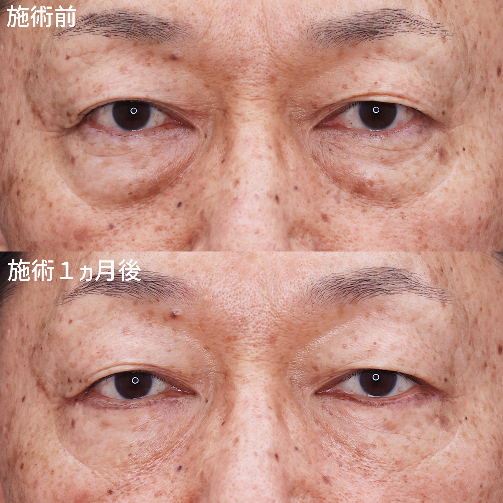 下眼瞼切開術（クマ・たるみとり）の症例写真 施術前後 