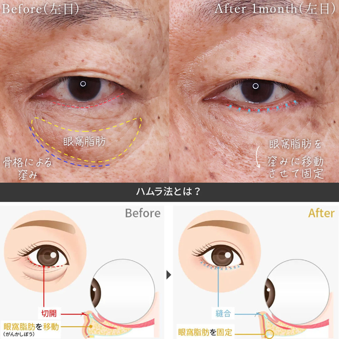 下眼瞼切開術（クマ・たるみとり）の症例写真 施術前後 