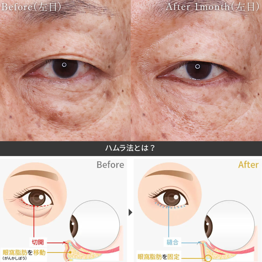 下眼瞼切開術（クマ・たるみとり）の症例写真 施術前後 