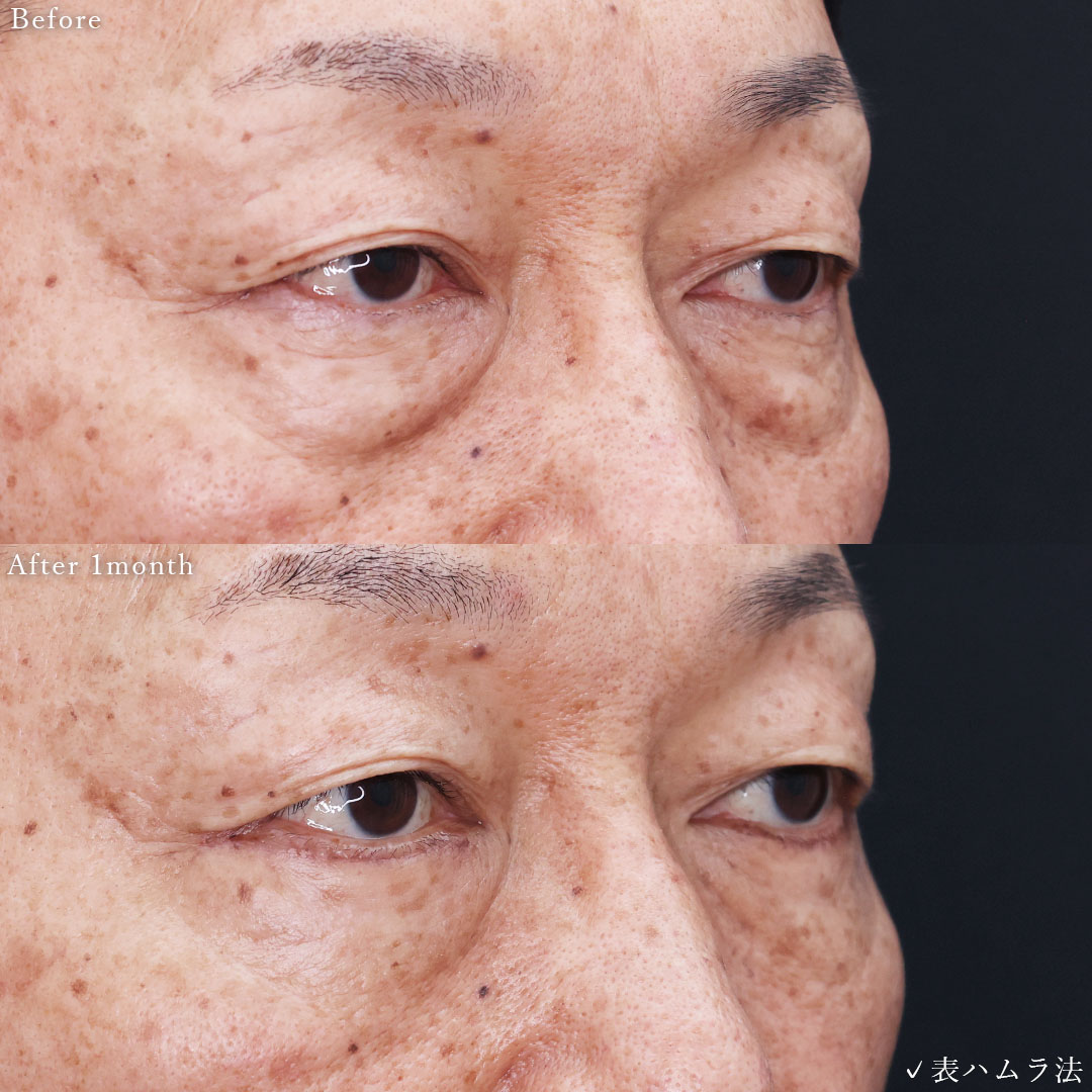 下眼瞼切開術（クマ・たるみとり）の症例写真 施術前後 