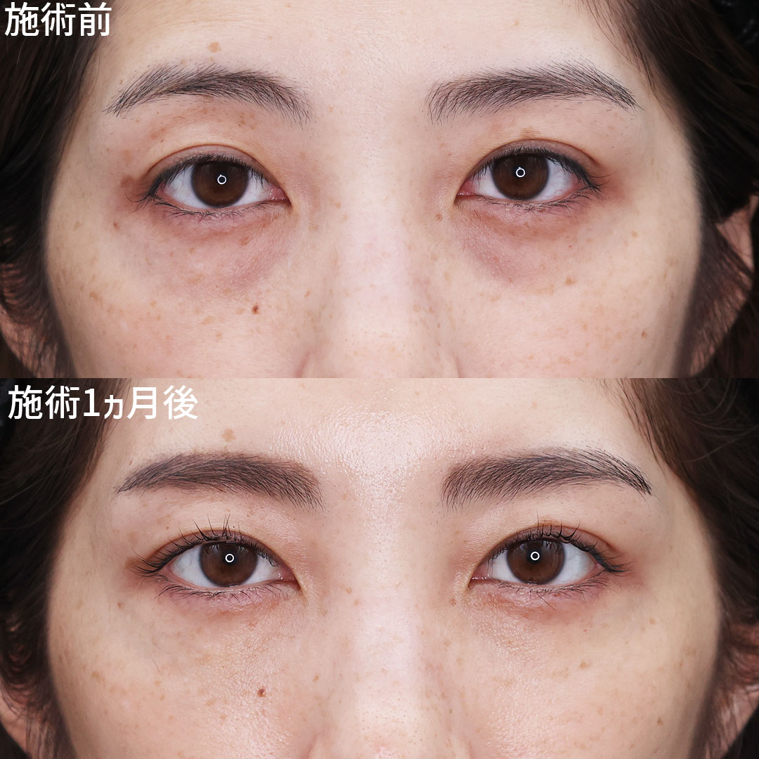 下眼瞼脱脂術(目の下のたるみ取り・目の下の脂肪ふくらみ取り)の症例写真 施術前後