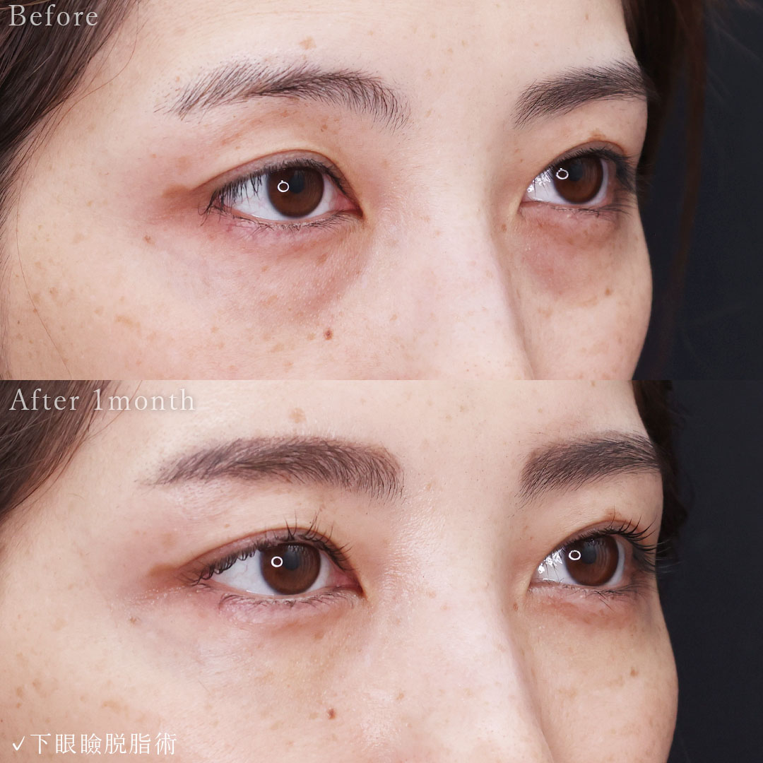 下眼瞼脱脂術(目の下のたるみ取り・目の下の脂肪ふくらみ取り)の症例写真 施術前後