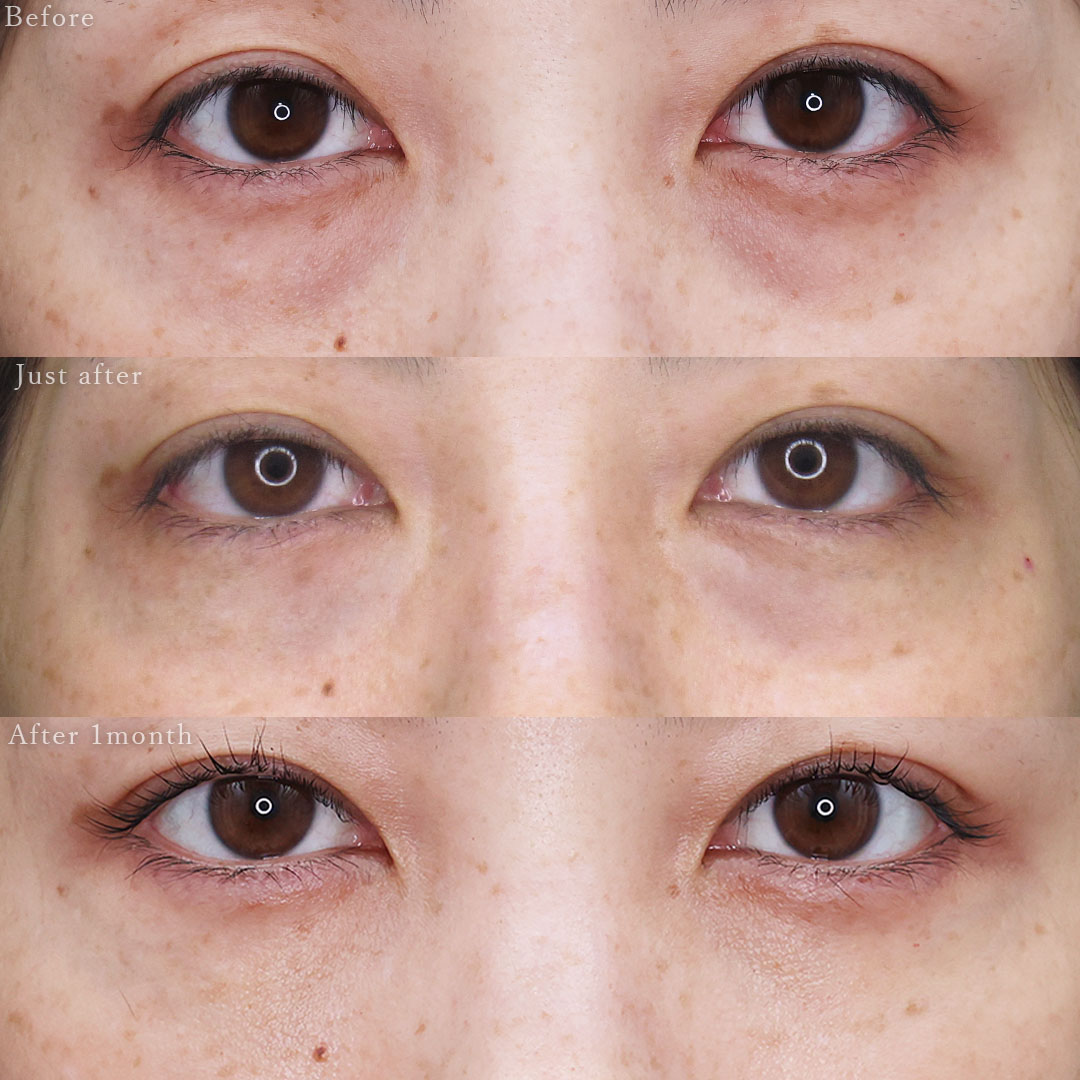 下眼瞼脱脂術(目の下のたるみ取り・目の下の脂肪ふくらみ取り)の症例写真 施術前後