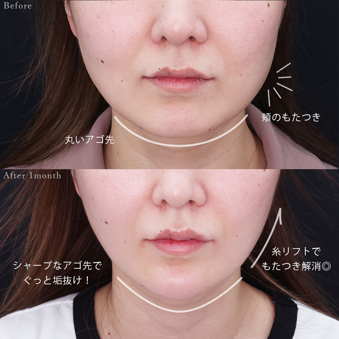 TAC式 ツヤ肌コラーゲンリフト®/顎のヒアルロン酸注射の症例写真 施術前後 