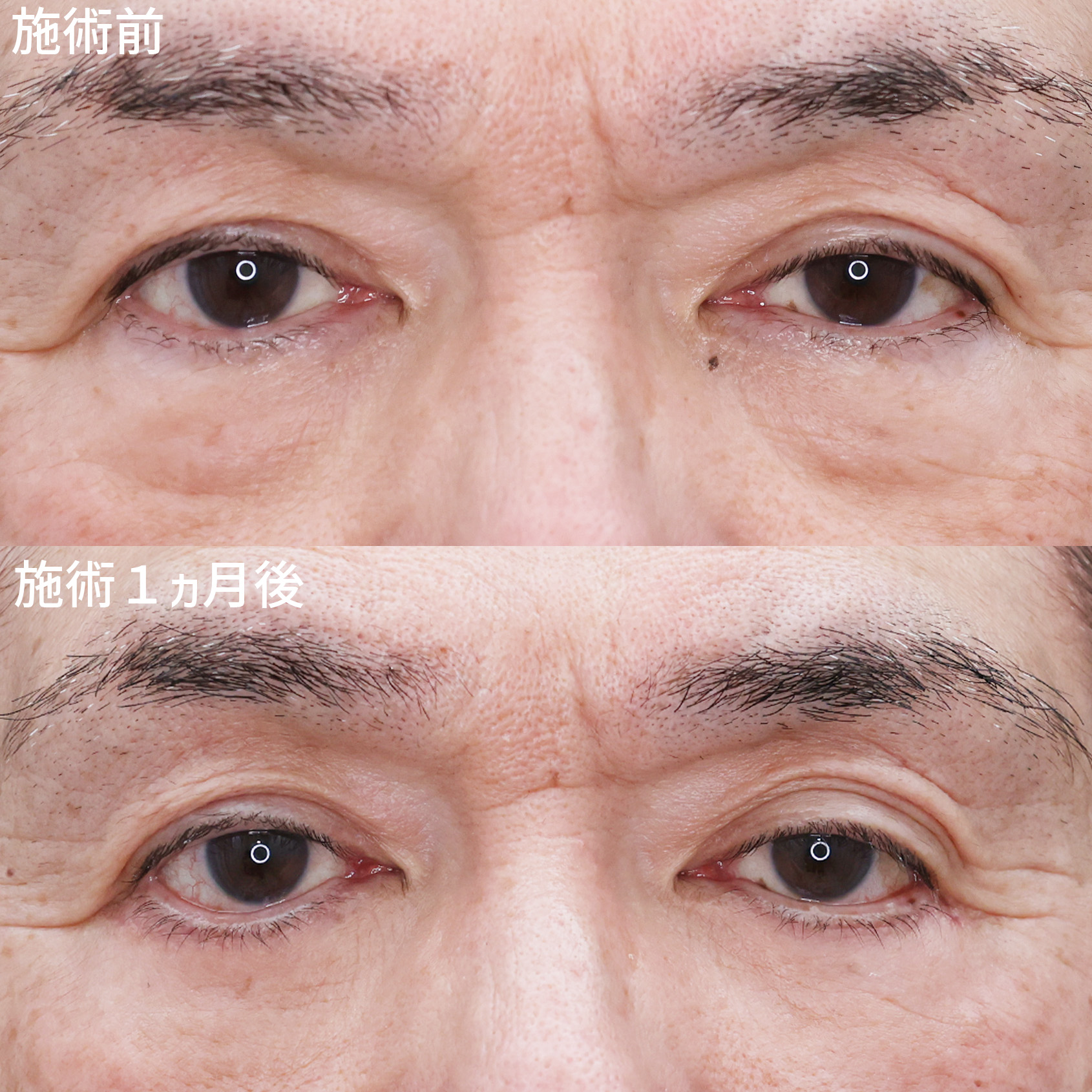 下眼瞼切開術(クマ・たるみとり)の症例写真 施術前後
