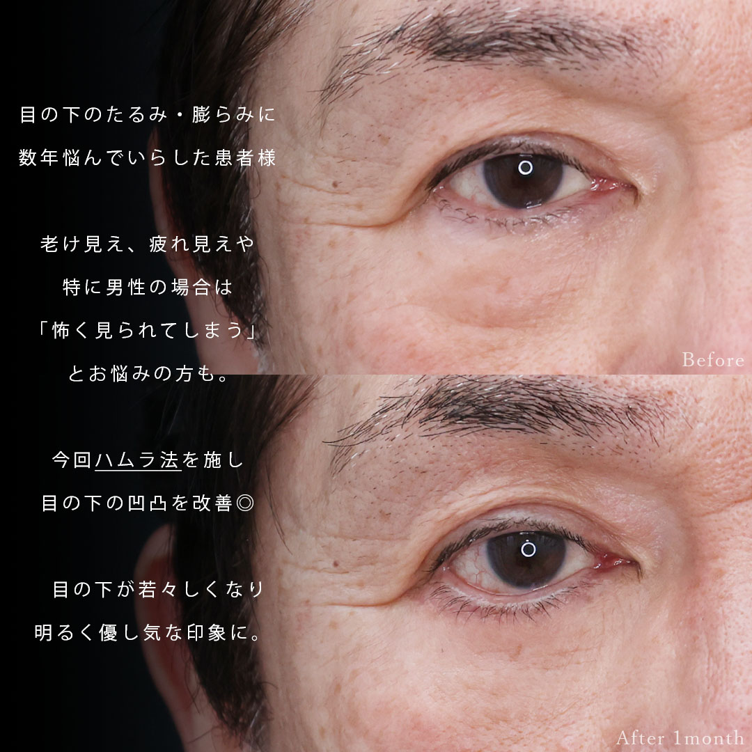 下眼瞼切開術(クマ・たるみとり)の症例写真 施術前後