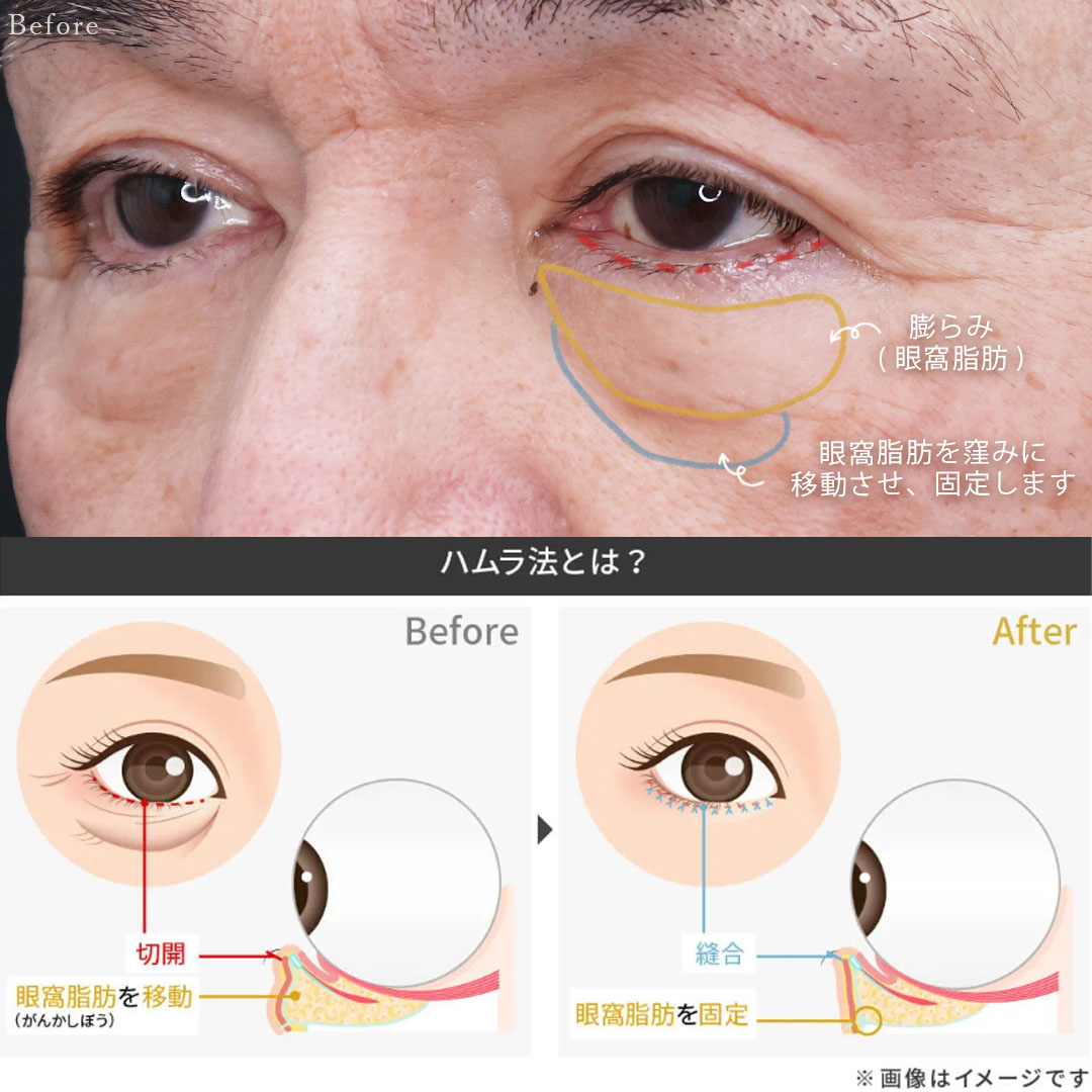 下眼瞼切開術(クマ・たるみとり)の症例写真 施術前後