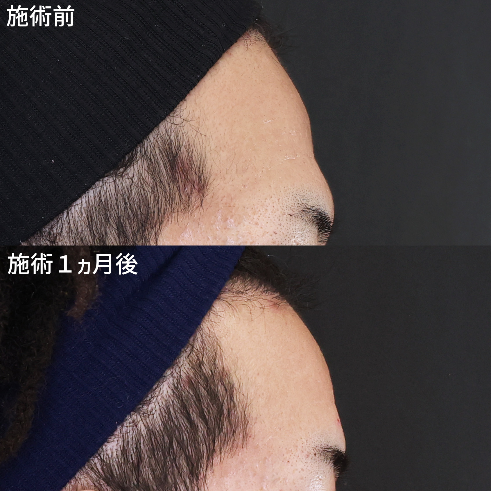 額のシワ、凹みを脂肪注入で改善！第一印象も柔らかく◎