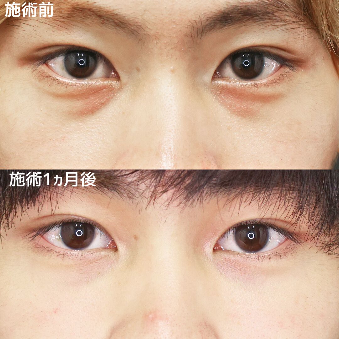 男性のクマ取り施術 ふくらみ取り治療で一気に若見え！