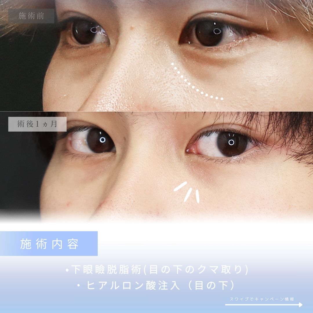 下眼瞼脱脂術（目の下のたるみ取り・目の下の脂肪ふくらみ取り）/目の下のヒアルロン酸注射の症例写真 施術前後 