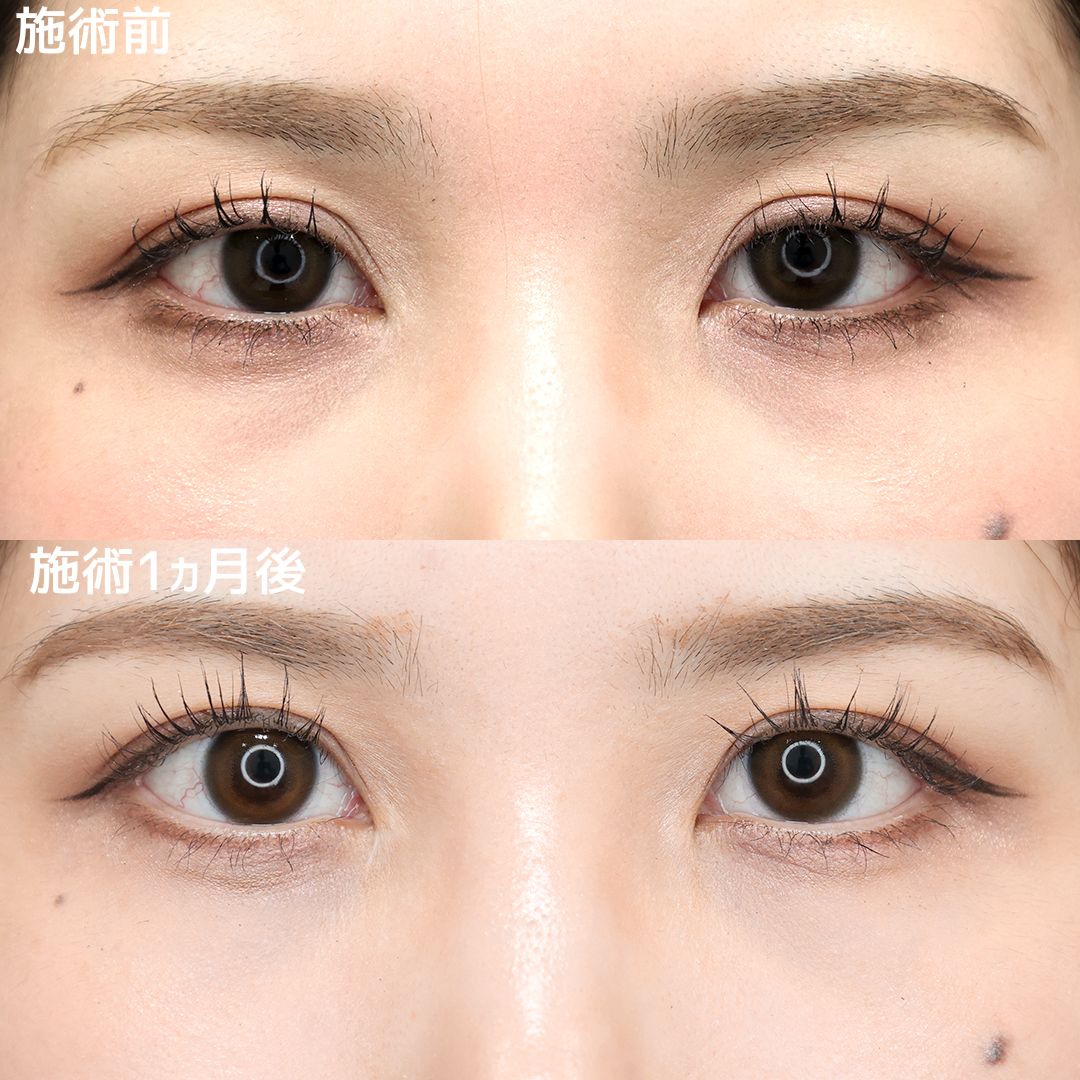 下眼瞼脱脂術（目の下のたるみ取り・目の下の脂肪ふくらみ取り）の症例写真 施術前後 