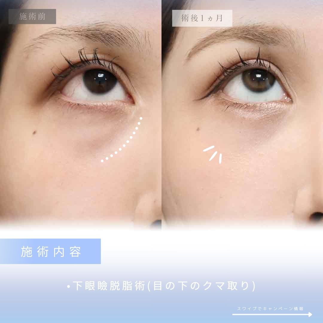 下眼瞼脱脂術（目の下のたるみ取り・目の下の脂肪ふくらみ取り）の症例写真 施術前後 