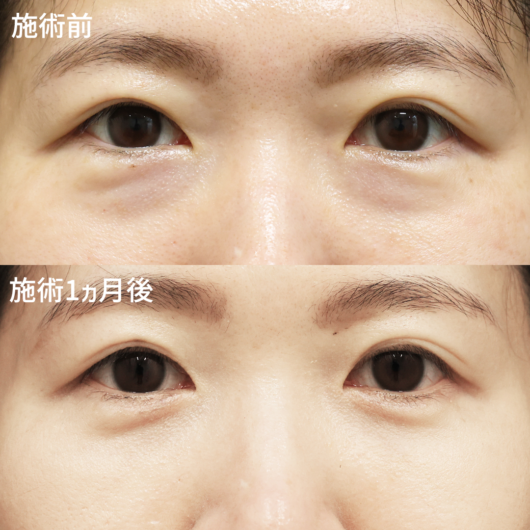 下眼瞼脱脂術（目の下のたるみ取り・目の下の脂肪ふくらみ取り）/顔の脂肪注入(コンデンスリッチフェイス)の症例写真 施術前後 