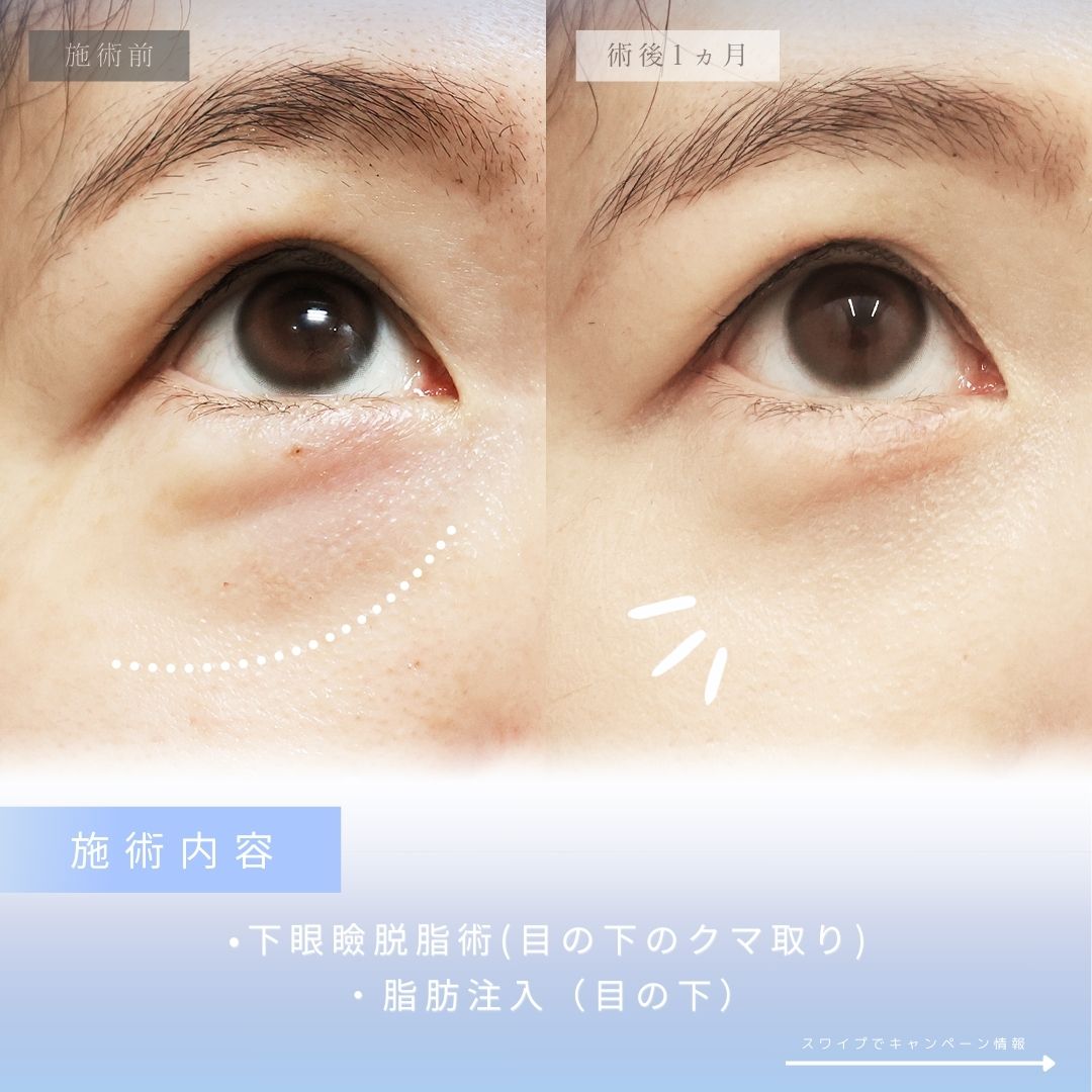 下眼瞼脱脂術（目の下のたるみ取り・目の下の脂肪ふくらみ取り）/顔の脂肪注入(コンデンスリッチフェイス)の症例写真 施術前後 