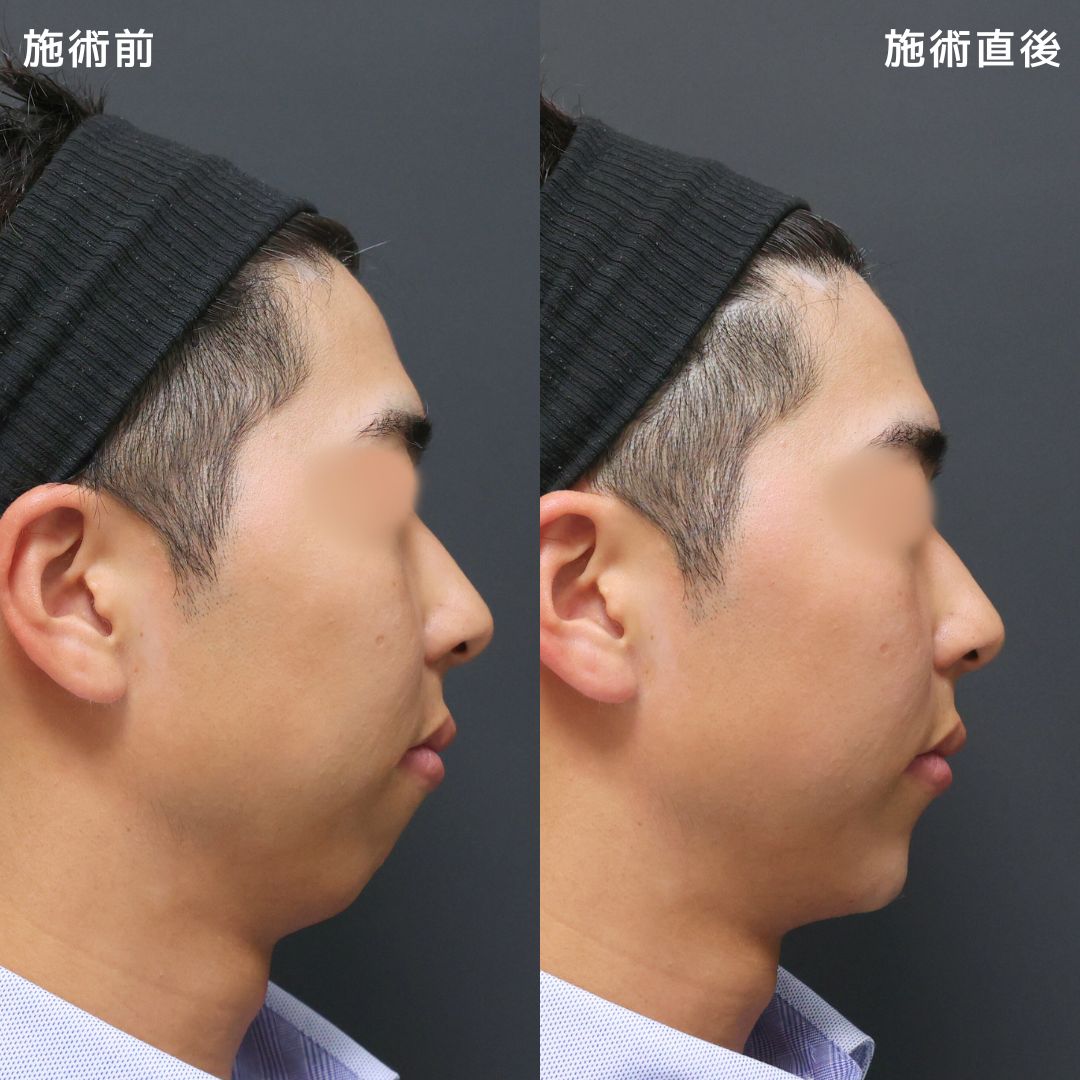 アゴでこんなに変わる！アゴ無しから「理想のイケメン顔」へ【顎のヒアルロン酸注射】