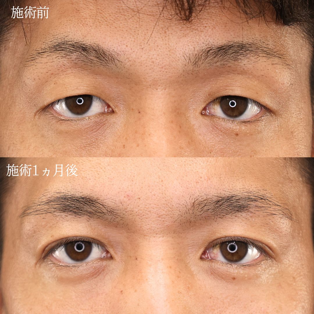 《20代メンズ》二重埋没法で眠そうな印象から凛々しい瞳に