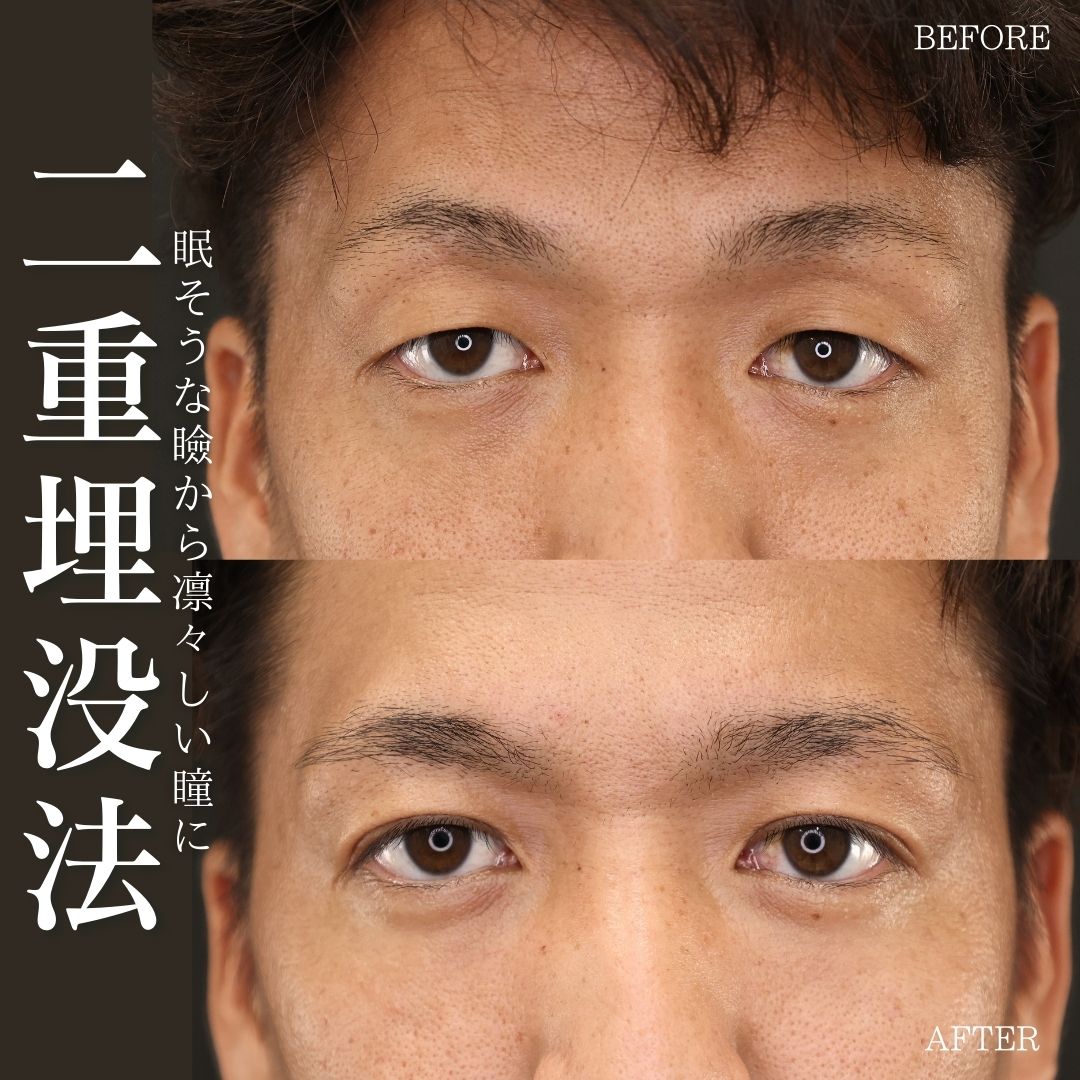 二重埋没法の症例写真 施術前後 