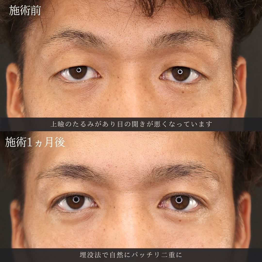 二重埋没法の症例写真 施術前後 