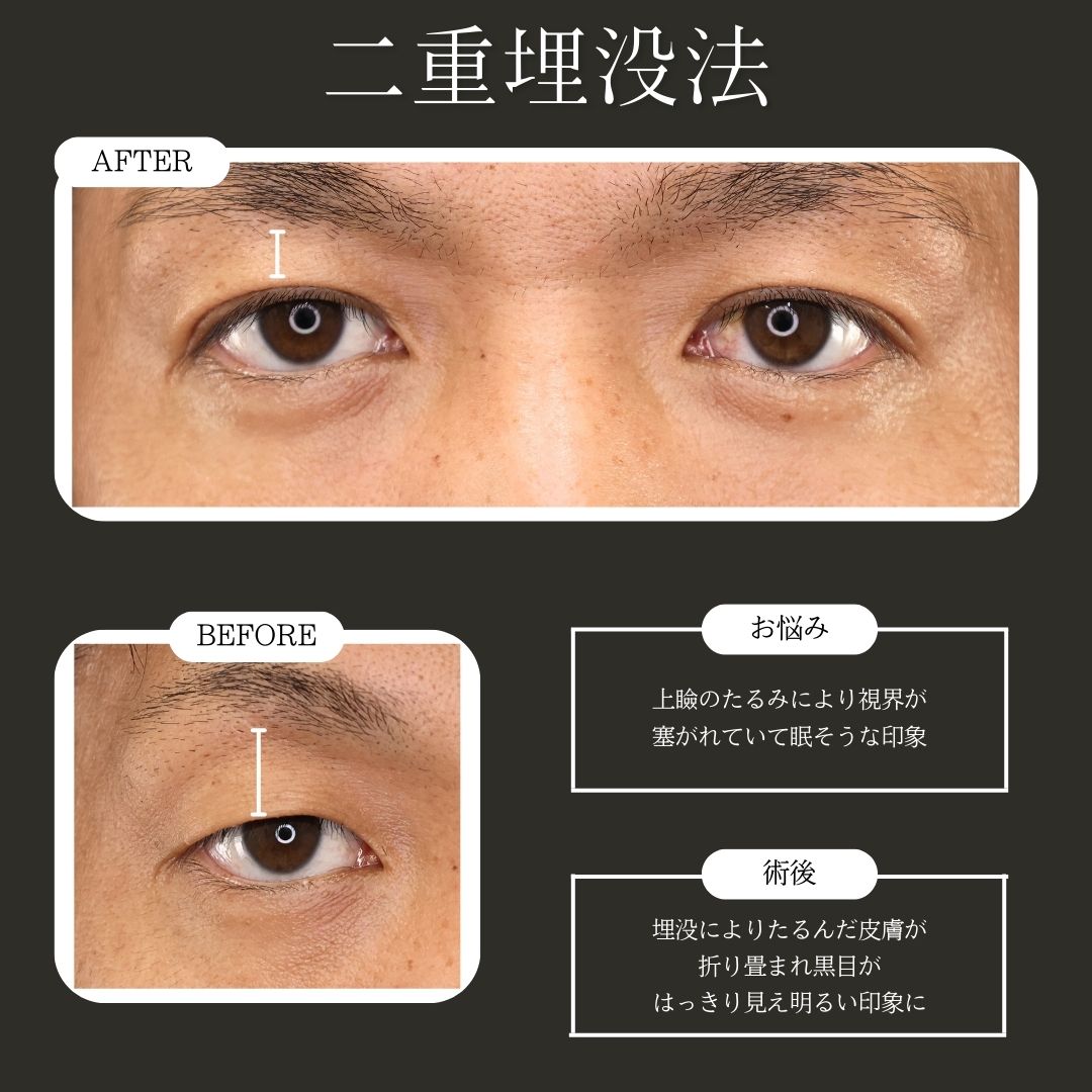 二重埋没法の症例写真 施術前後 