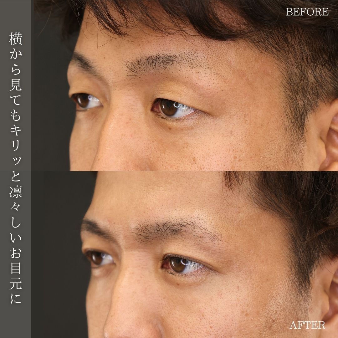 二重埋没法の症例写真 施術前後 