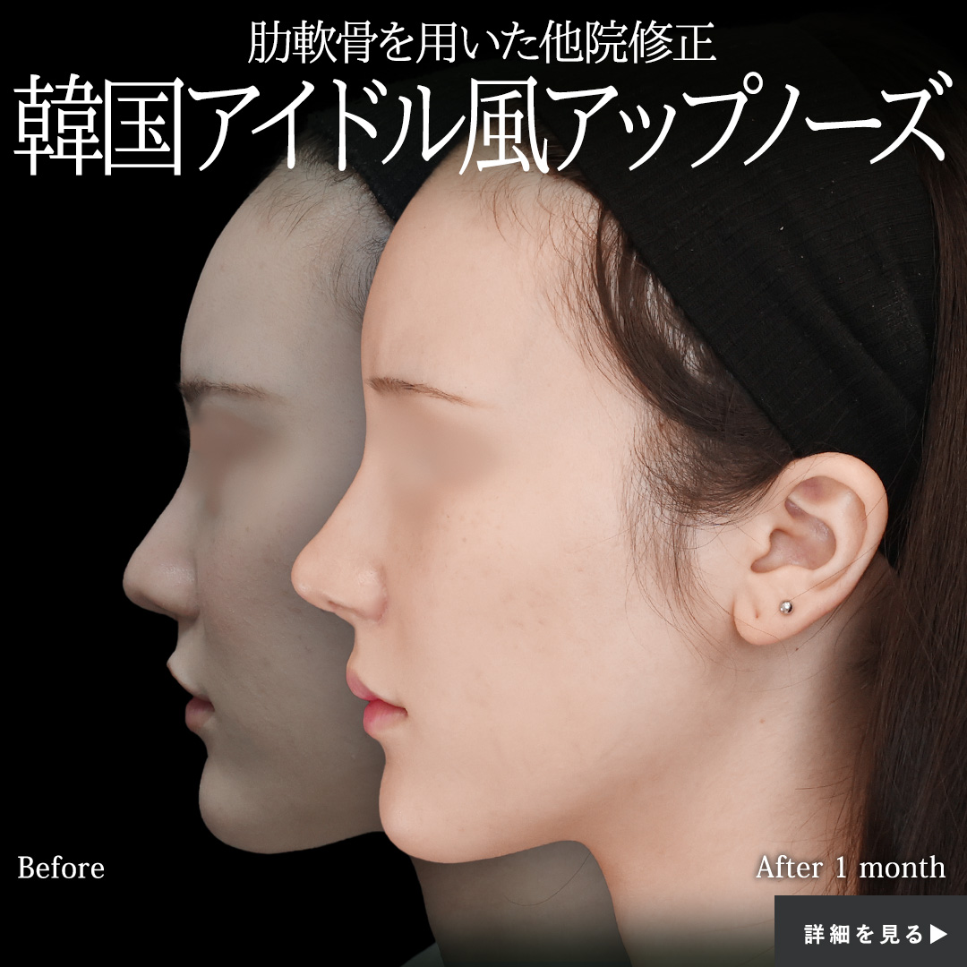 隆鼻術（プロテーゼ・自家組織）/鼻中隔延長術/鼻孔縁挙上術の症例写真 施術前後 