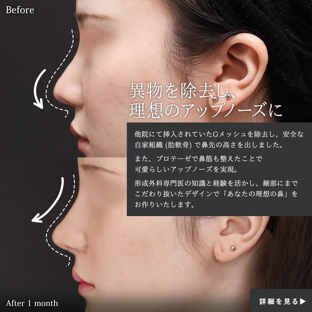 隆鼻術（プロテーゼ・自家組織）/鼻中隔延長術/鼻孔縁挙上術の症例写真 施術前後 