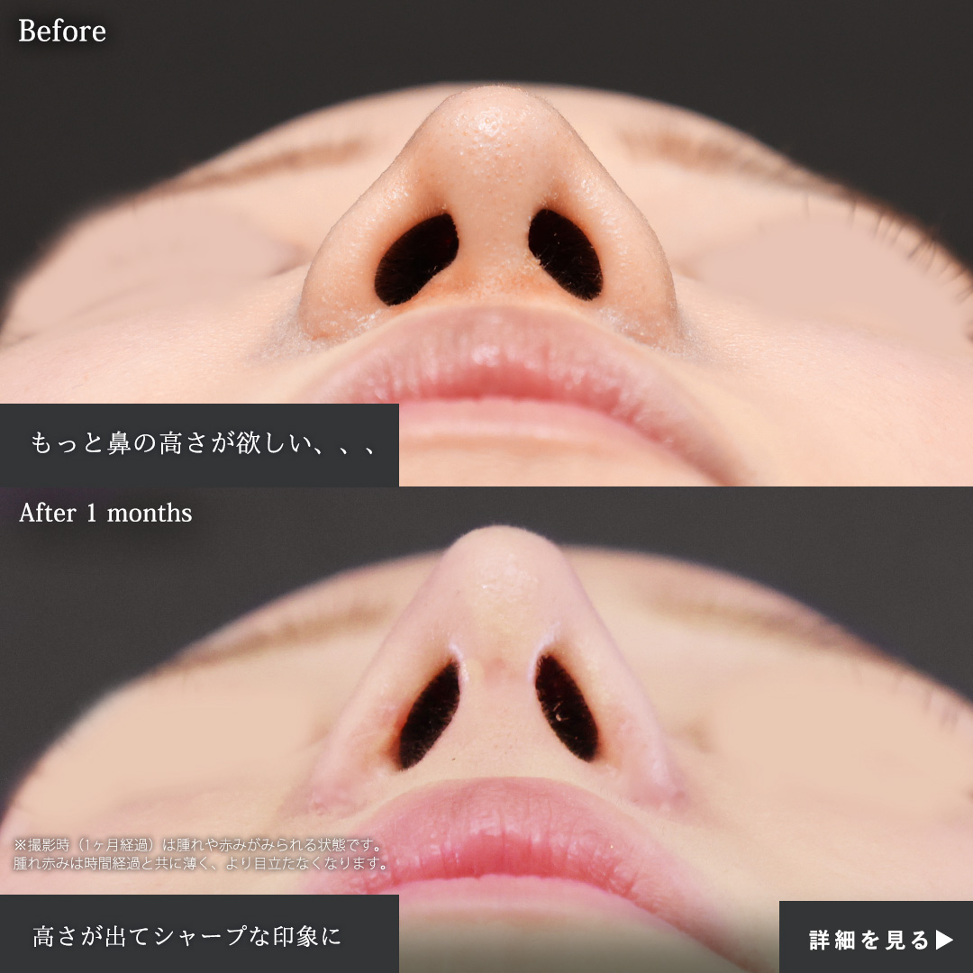 隆鼻術（プロテーゼ・自家組織）/鼻中隔延長術/鼻孔縁挙上術の症例写真 施術前後 