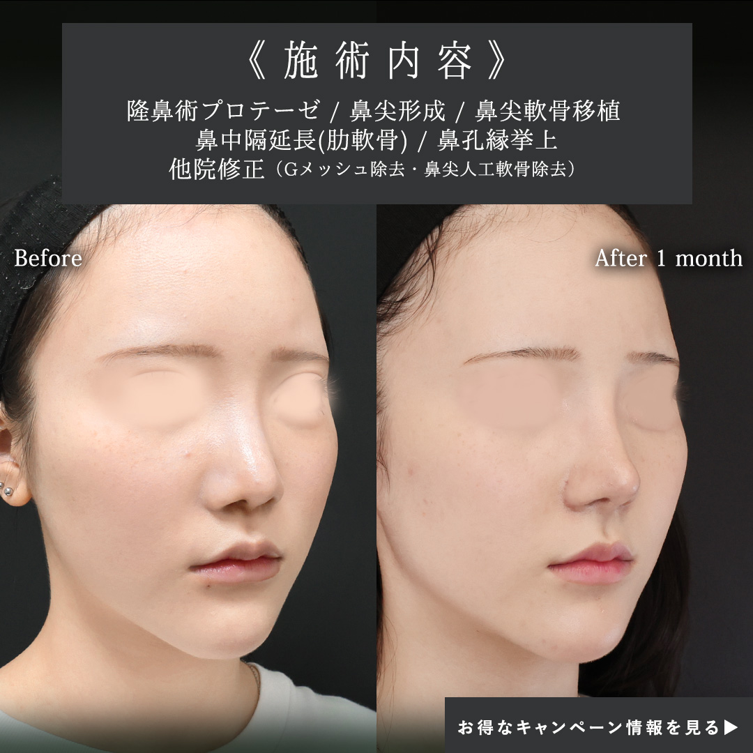 隆鼻術（プロテーゼ・自家組織）/鼻中隔延長術/鼻孔縁挙上術の症例写真 施術前後 