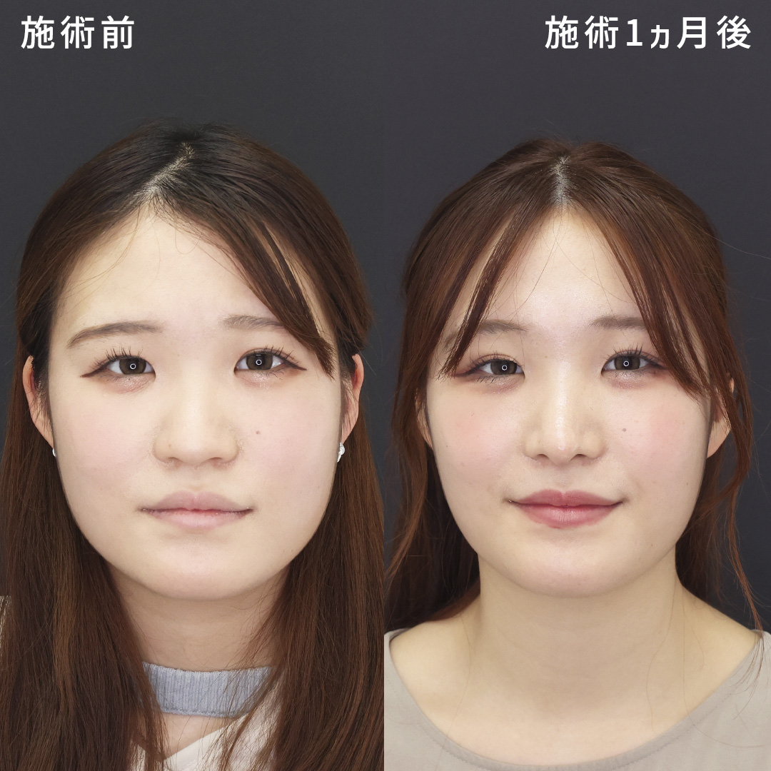 【形成外科専門医執刀】だんご鼻を忘れ鼻にアップデート｜自家組織で鼻整形