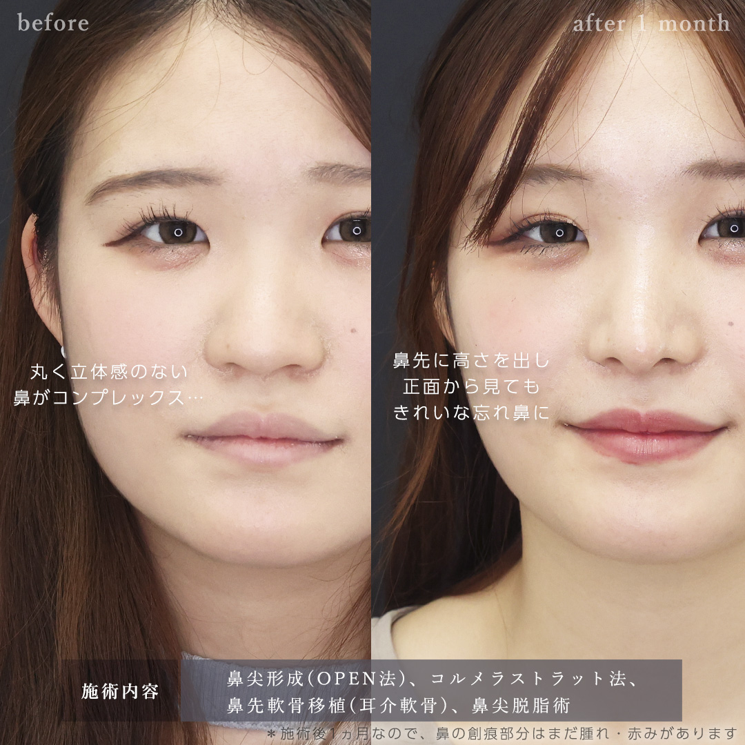 鼻尖形成・鼻尖縮小/鼻先軟骨移植/鼻：その他の症例写真 施術前後 
