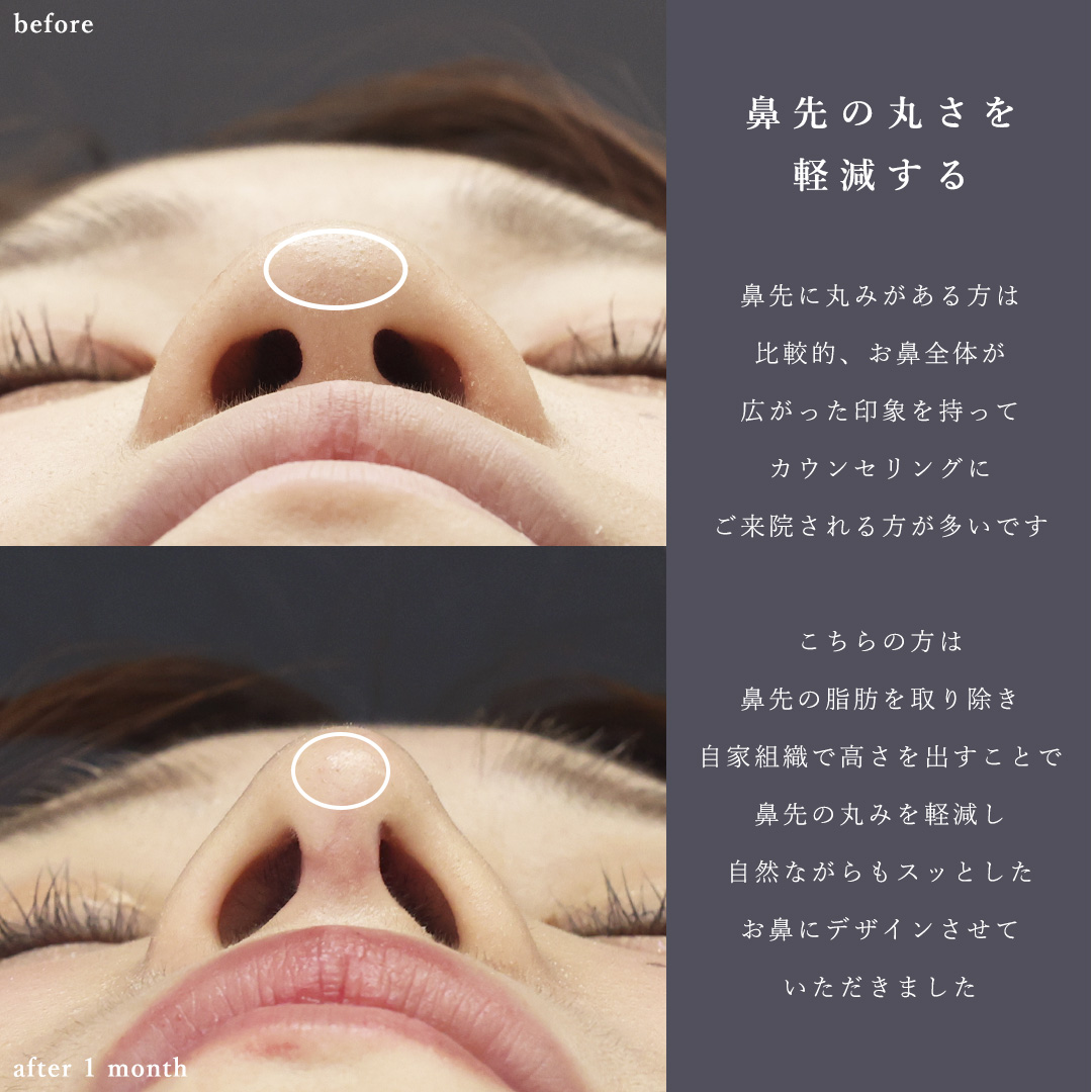 鼻尖形成・鼻尖縮小/鼻先軟骨移植/鼻：その他の症例写真 施術前後 