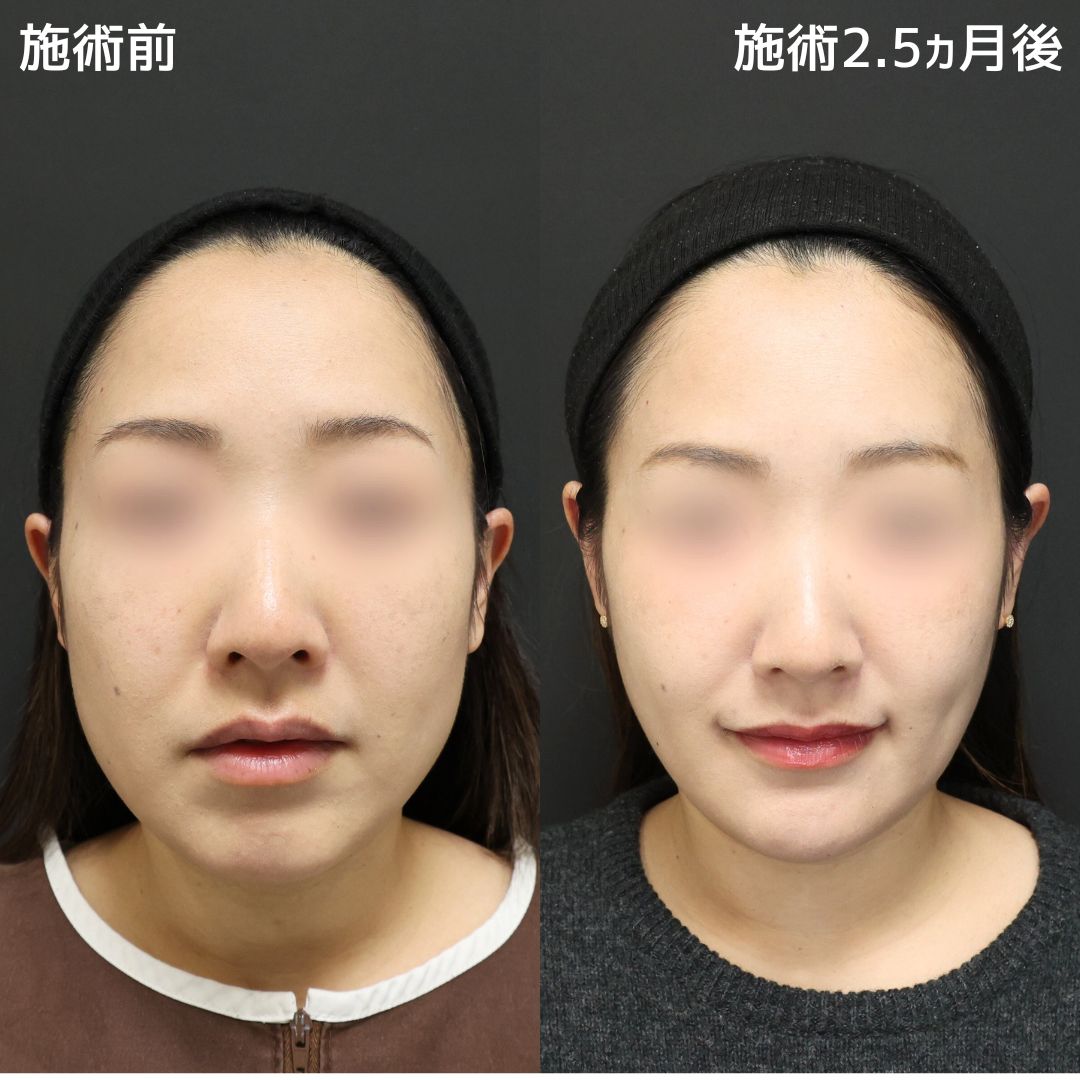 《トータルビューティー✨》まりえ先生によるオーダーメイド小顔術