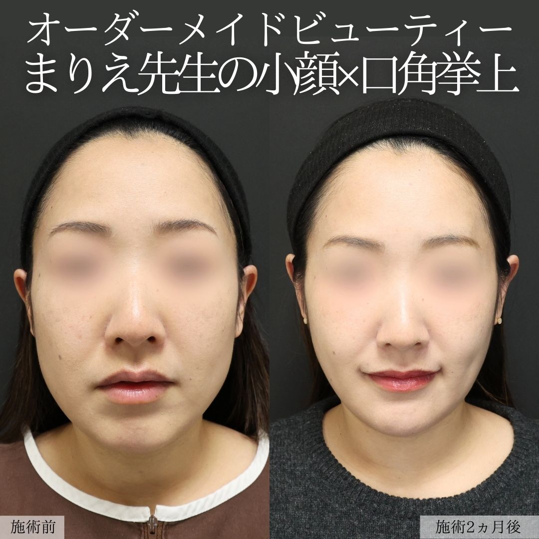 バッカルファット除去/ジョールファット除去/顔の脂肪吸引の症例写真 施術前後 