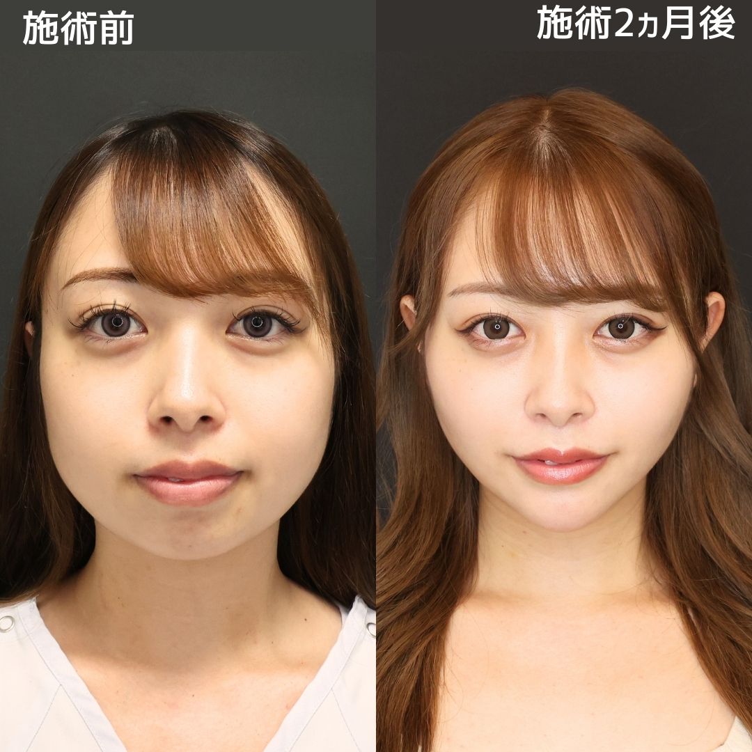 《Dr.Marieのオーダーメイド小顔術》街でナンパされて困ってます！