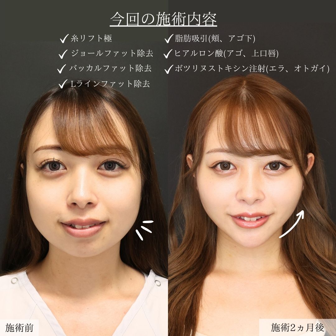 バッカルファット除去/顔の脂肪吸引/ジョールファット除去の症例写真 施術前後