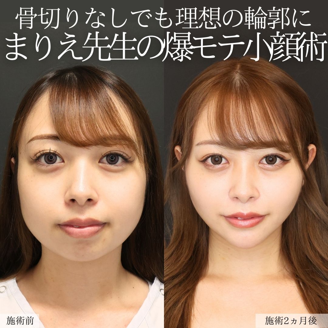 バッカルファット除去/顔の脂肪吸引/ジョールファット除去の症例写真 施術前後 