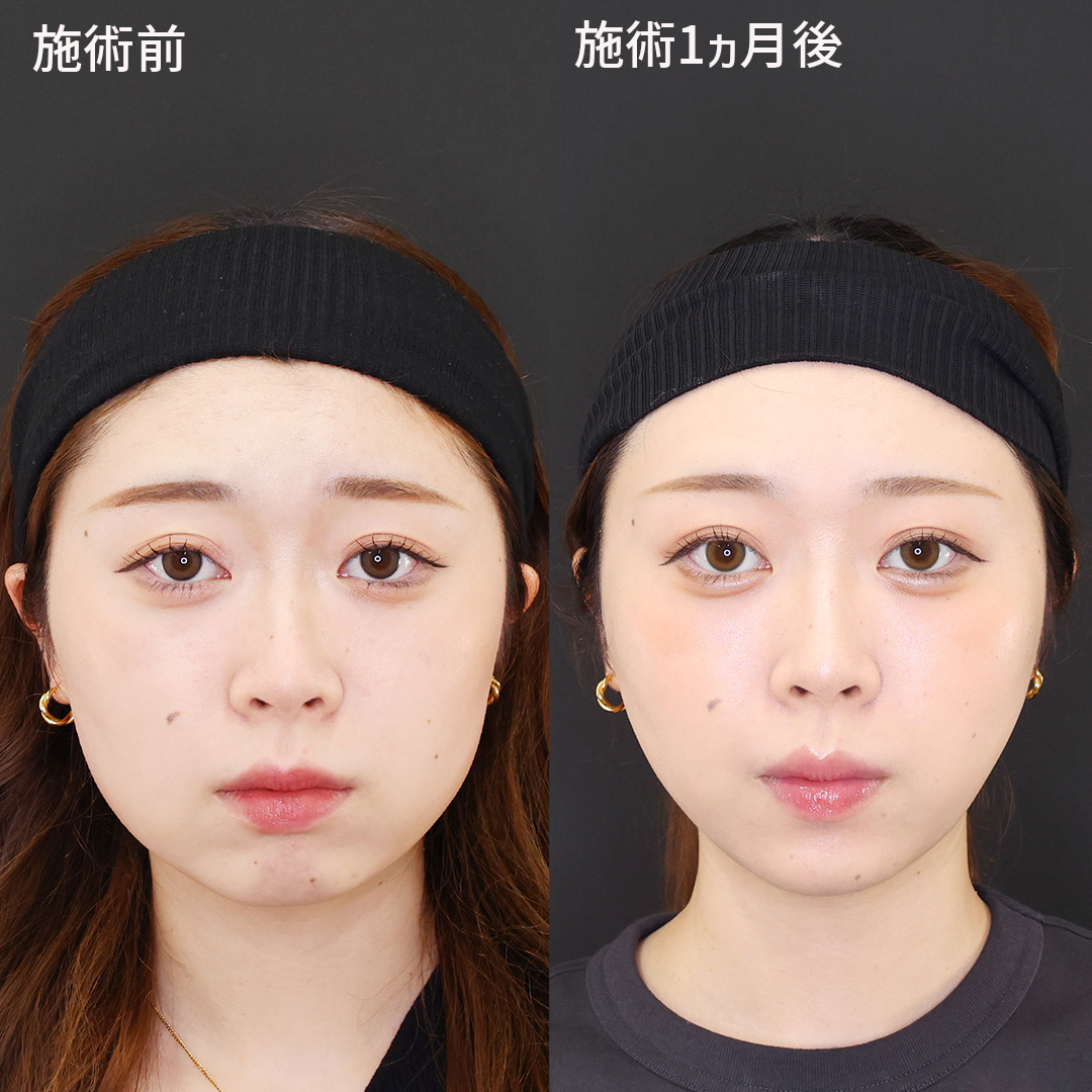 【本来の輪郭を引き出す！】女優級小顔術