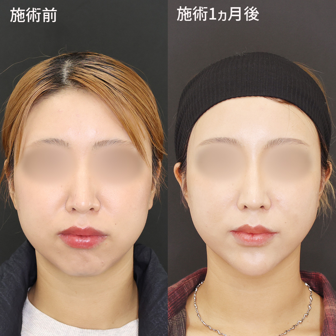 【本来の輪郭を引き出す】理想のVラインを形成✨