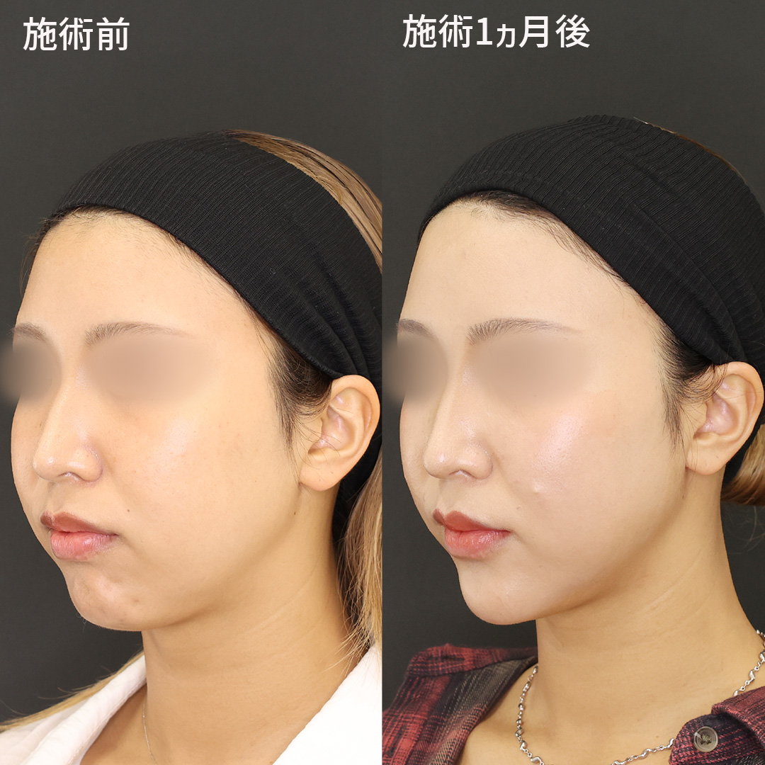 TAC式 ツヤ肌コラーゲンリフト®/ナゾラビアルファット除去/顎のヒアルロン酸注射の症例写真 施術前後 